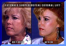 Extended Subperiosteal Coronal Lift